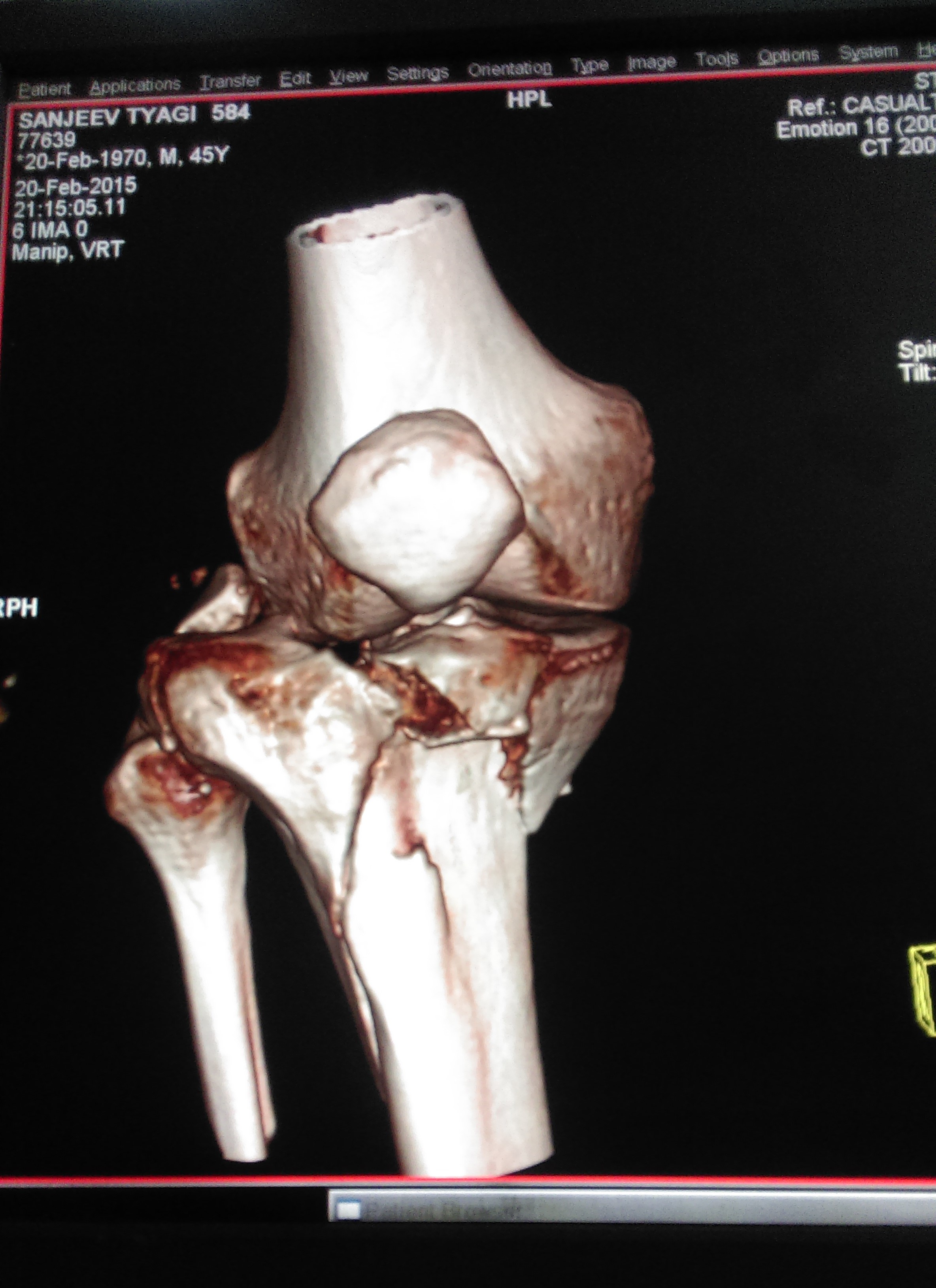 When do I Need a Knee Replacement Surgery? | Dr. Atul Jain