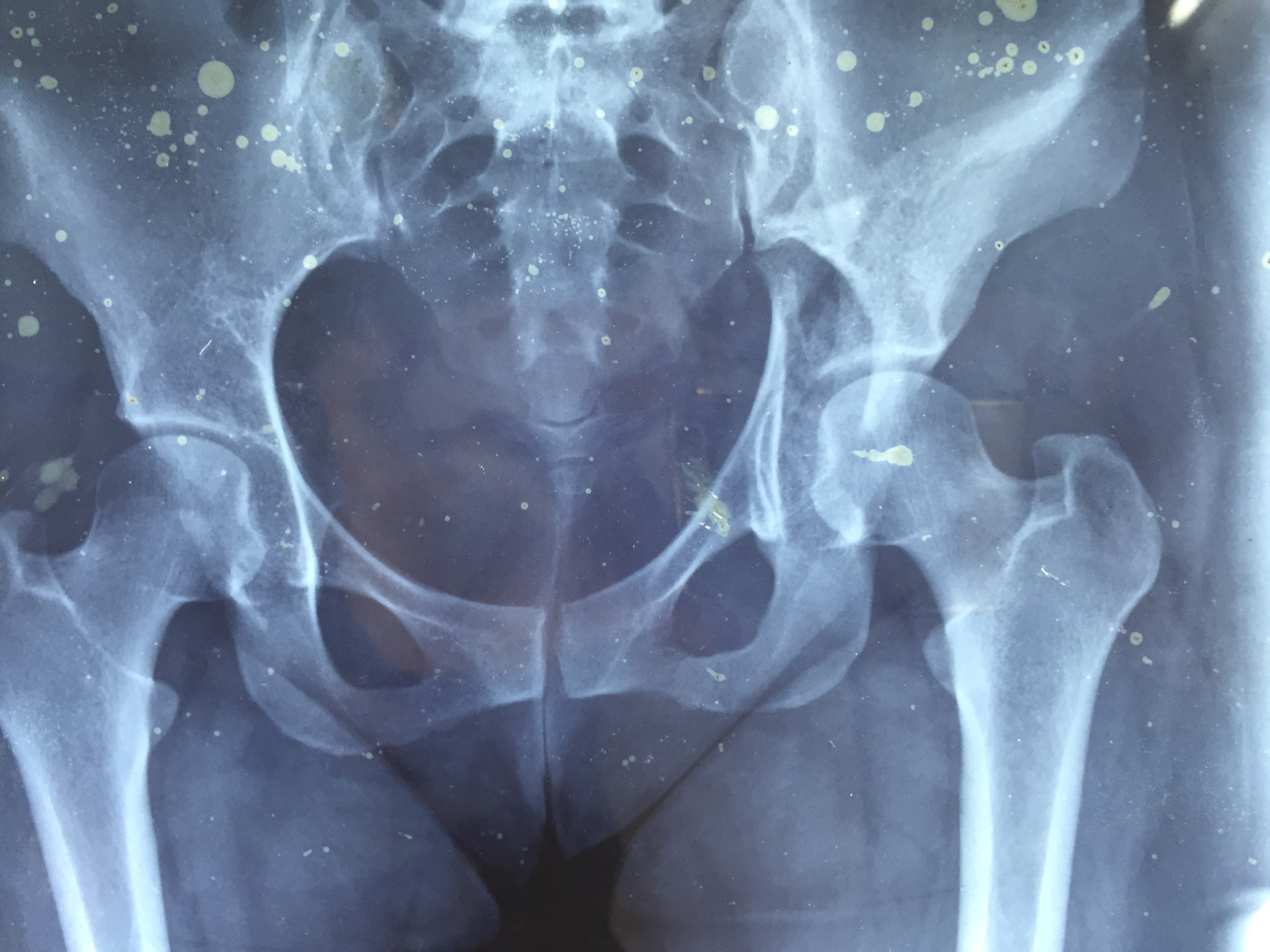 When do I Need a Knee Replacement Surgery? | Dr. Atul Jain